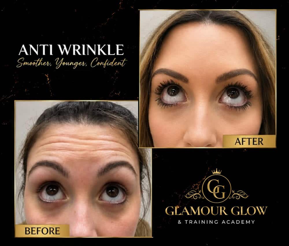 Anti-wrinkle treatment before and after results in Torquay