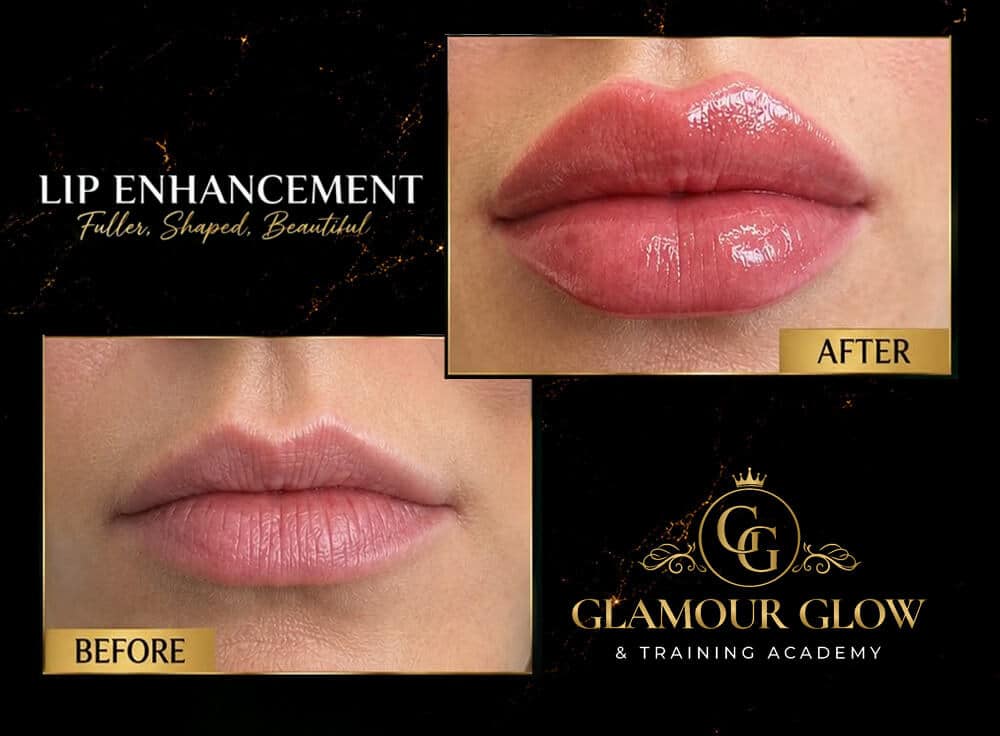 Lip enhancement before and after results at Glamour Glow Torquay
